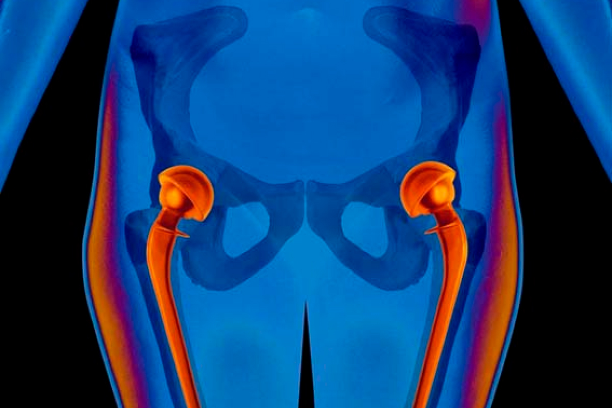 人工関節、人工骨